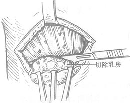 图1 乳房单纯切除术