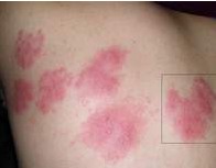 Herpes Zoster Picture Image on MedicineNet.com