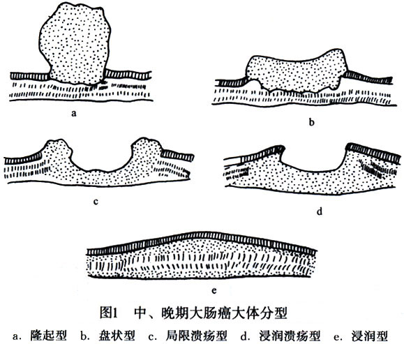 盆腔内有较广泛浸润